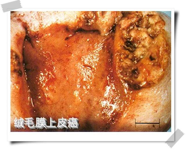 卵巢上皮卵巢癌