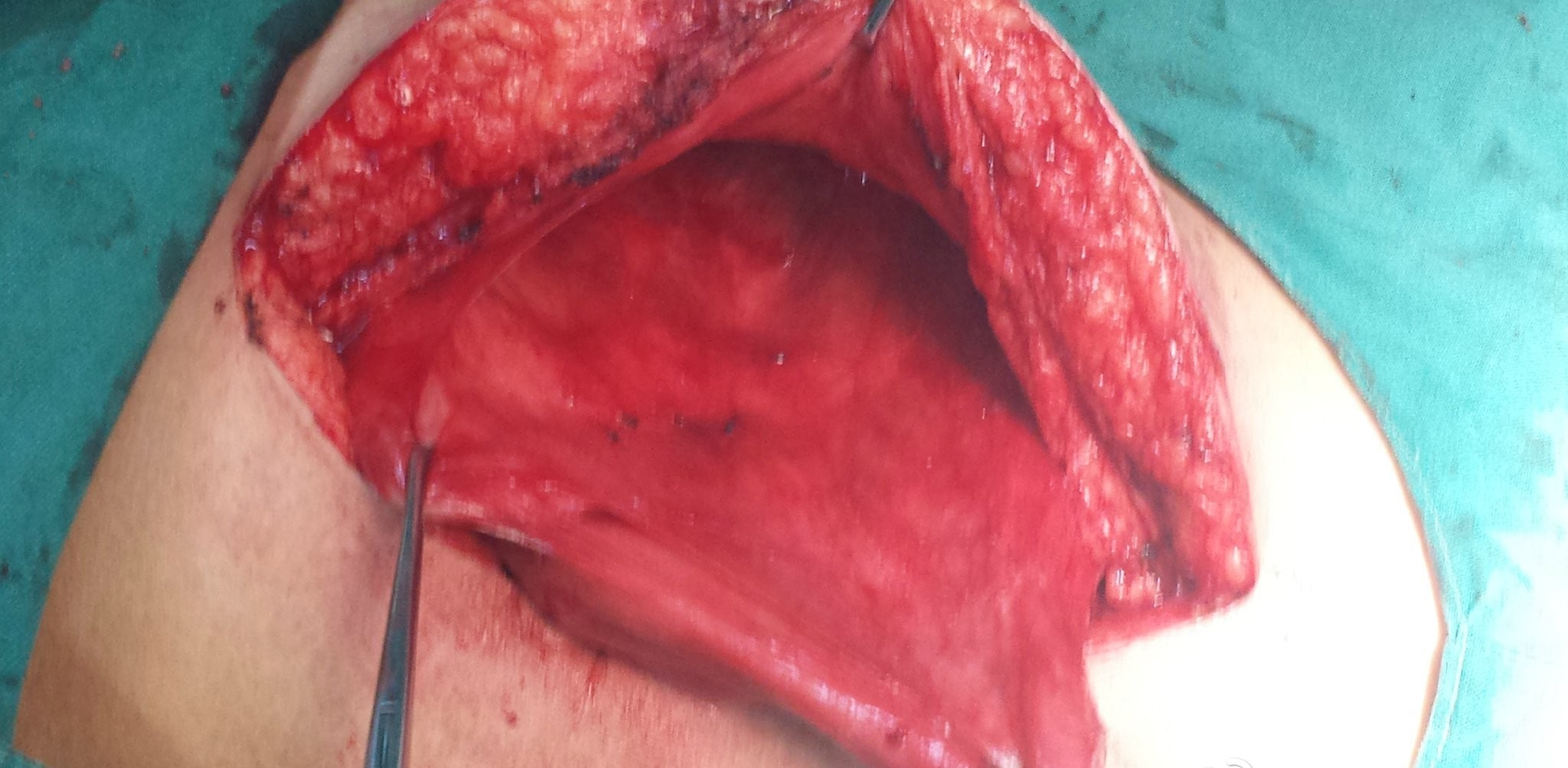 手術治療腸粘連的