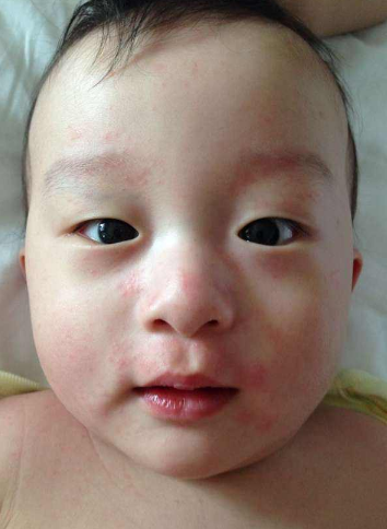 臉上皮膚過敏症狀