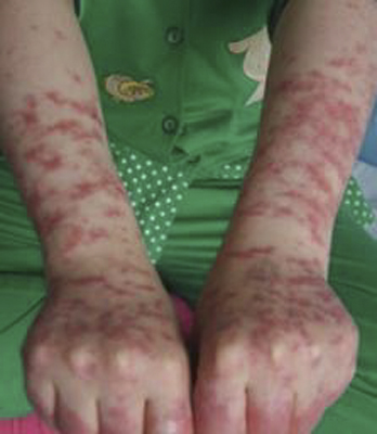 系統性紅斑狼瘡診斷標準 (42) 