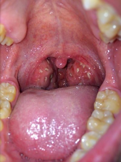 食道炎的症狀圖 (9) 