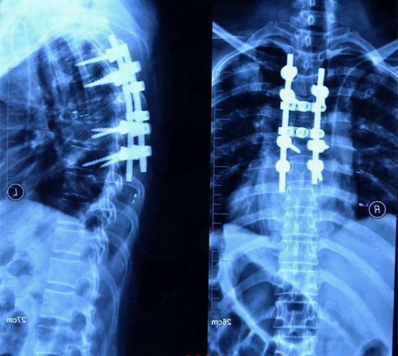 肺腺癌胸椎轉移瘤