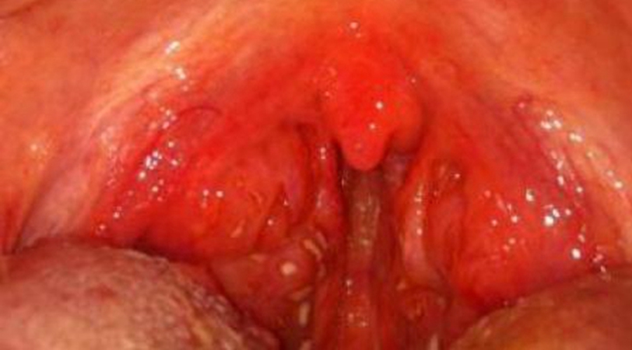 孕期的急性咽炎的