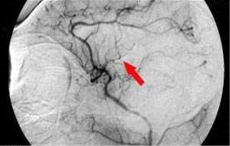 腦供血不足血管造影