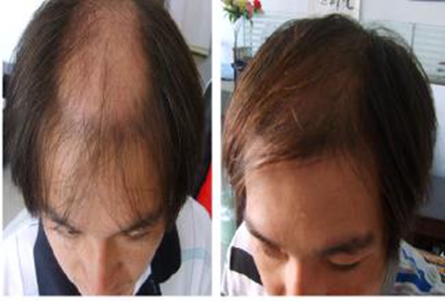 橋本甲狀腺炎與脫髮