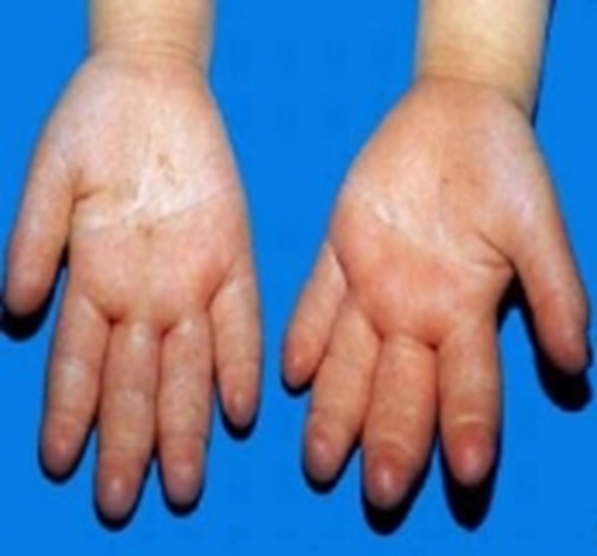 糖尿病腎病手部腫起