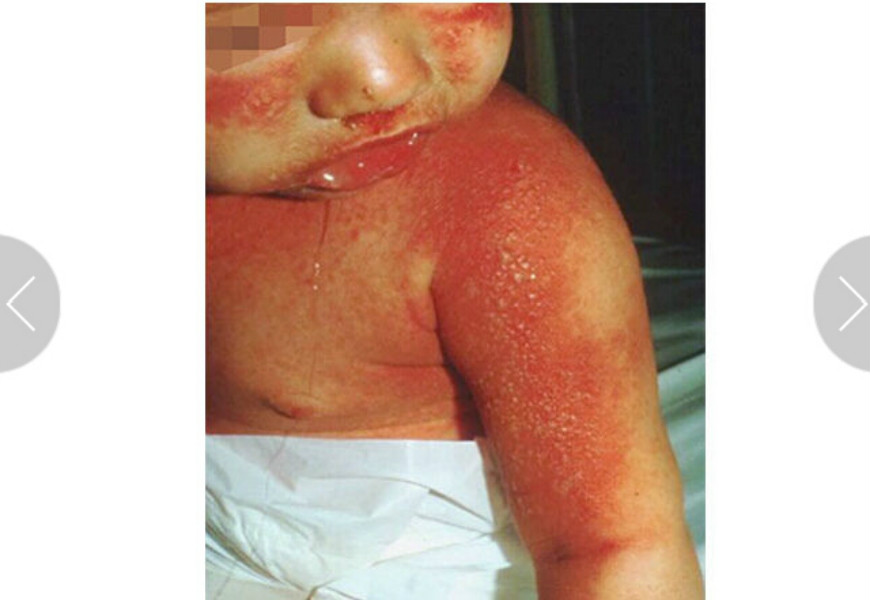 小兒全身皮膚念珠菌病