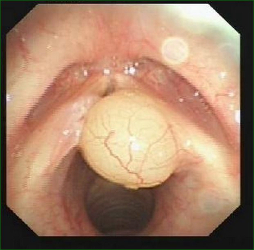 要重視聲帶息肉的防治