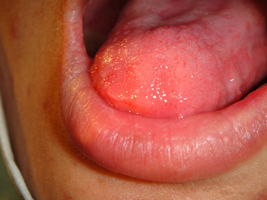 舌癌的初早期症狀