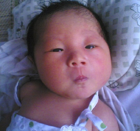 嬰兒左側痙攣性斜頸