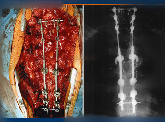 硬膜下血腫 (39) 