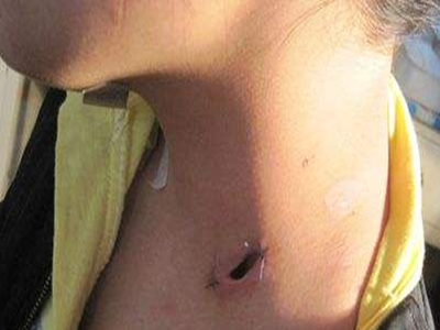 慢性淋巴結炎 (9) 