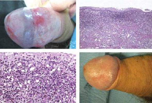 黴菌性龜頭炎 (50) 