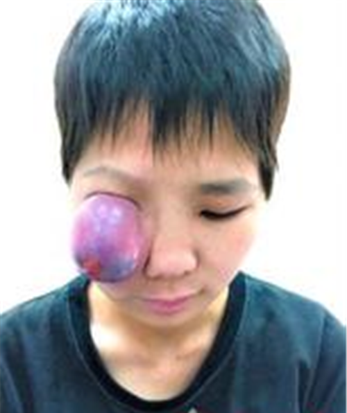 頭顱良性骨腫瘤