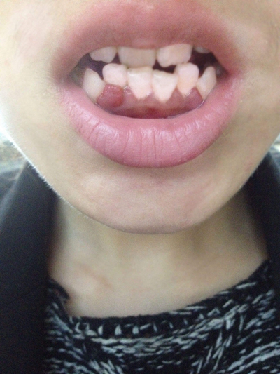 牙齦炎和牙周炎