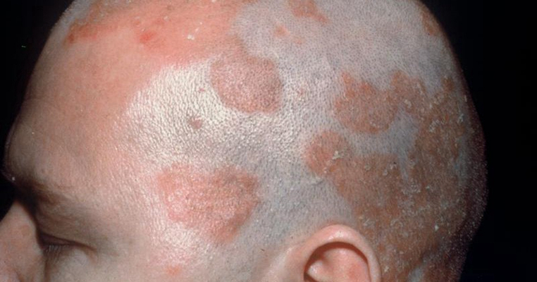 頭皮脂溢性皮炎 (7) 