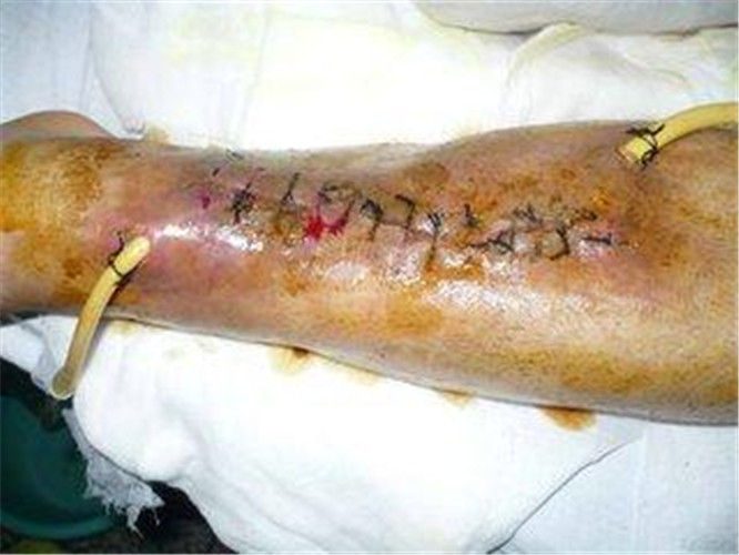 中期骨髓炎醫治