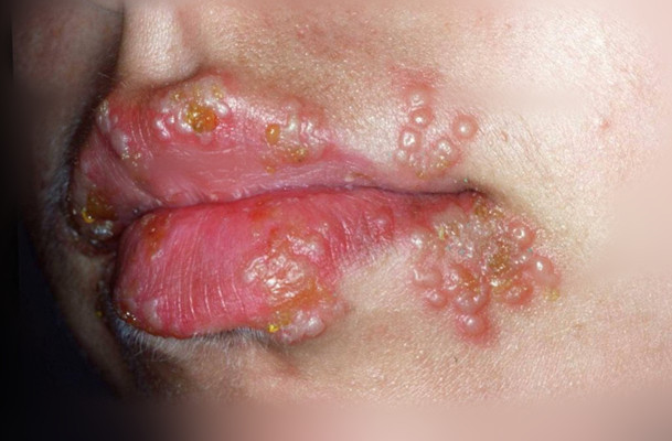 嘴上長皰疹 (48) 