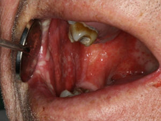 咽喉潰瘍 (40) 