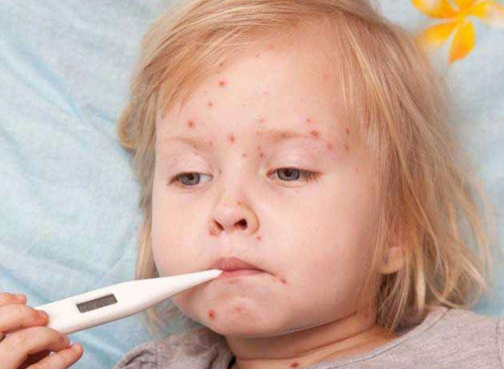 長水痘的症狀 (6) 