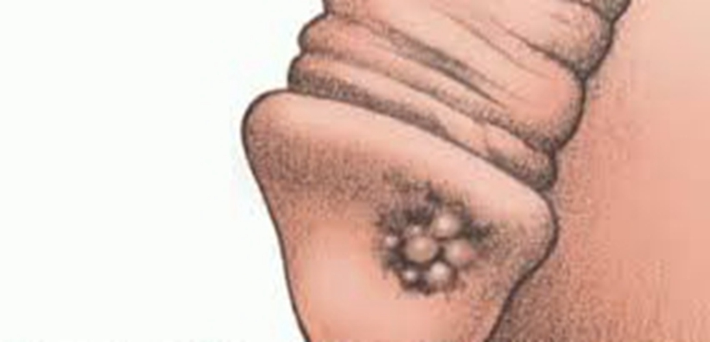 早期陰莖癌的症狀