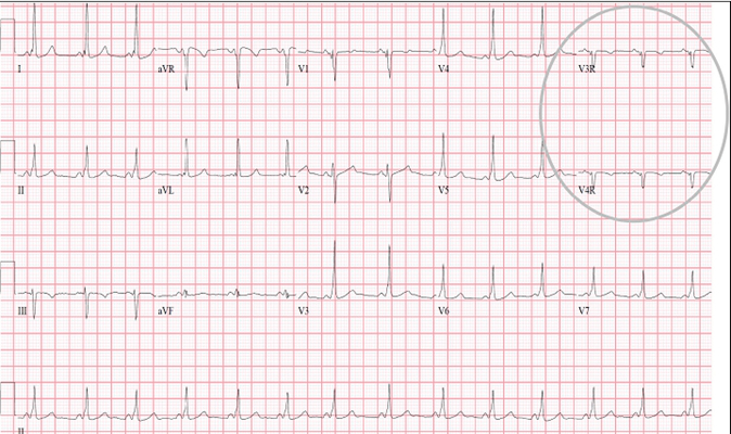 房顫心電圖特點 (61) 