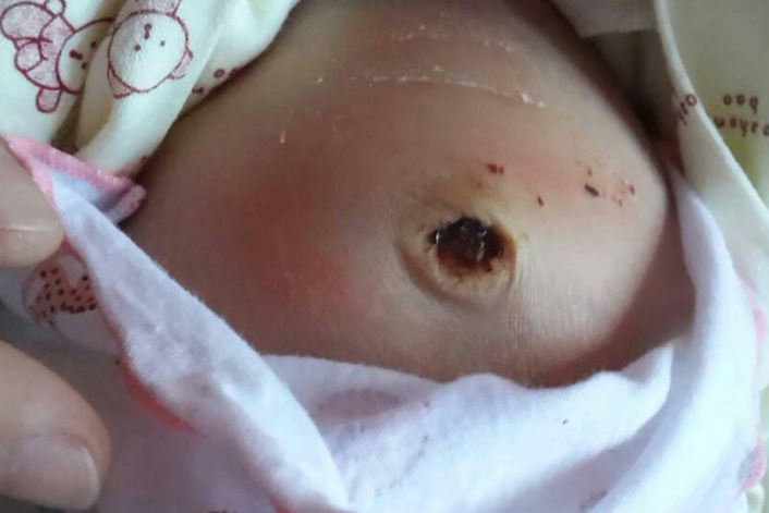 寶寶臍帶脫落後