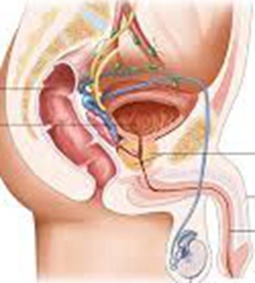 早期的陰莖癌的圖解