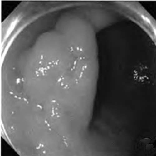 萎縮出血性慢性胃炎