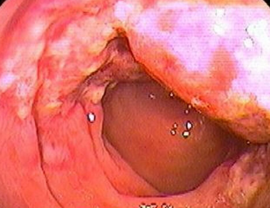 小腸克羅恩病的
