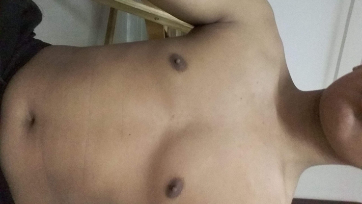 男生胸部突出 (49) 