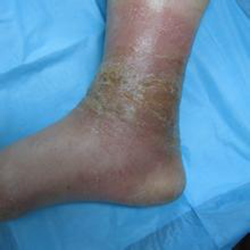 腳部日光性皮炎