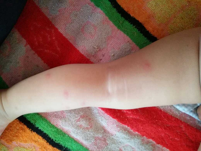 症狀真實流感腿部成人