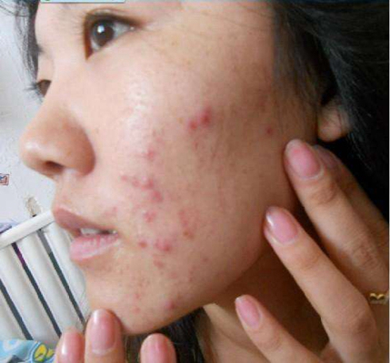 血熱的症狀痘痘