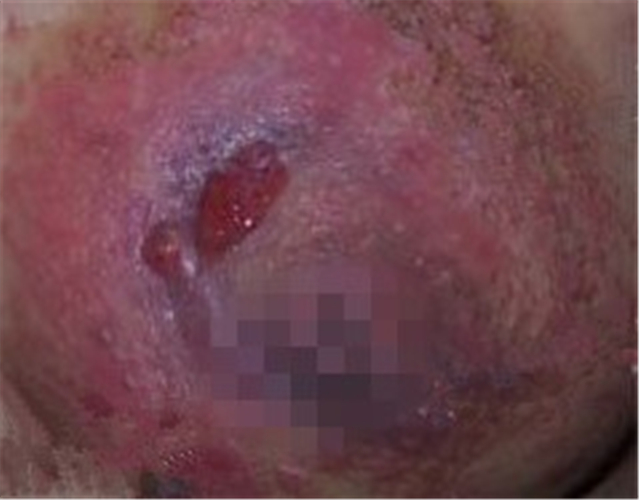 有些潰爛的乳腺炎