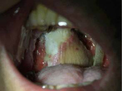 扁桃體癌圖  (69) 