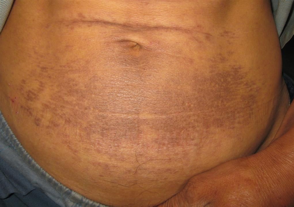 肚子上的皮膚黑變病