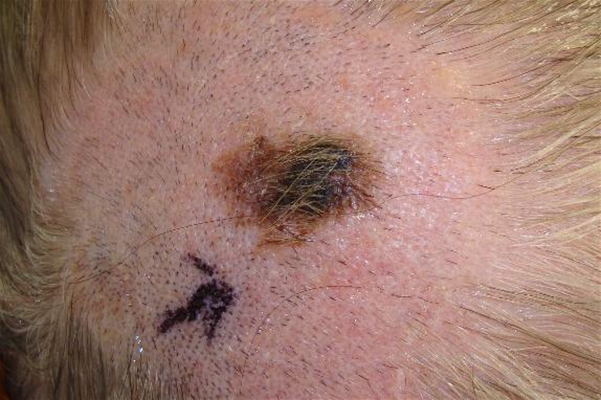 黑痣癌變的徵兆