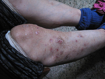 結節性癢疹 (46) 