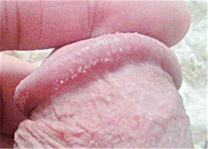 男性尿道假性溼疣