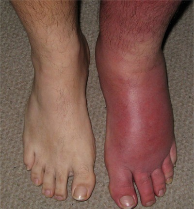 肢端肥大症  (39) 