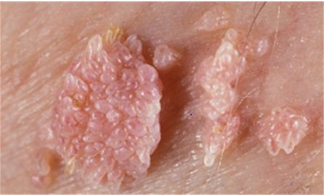 性病性淋巴肉芽腫套圖 (6) 