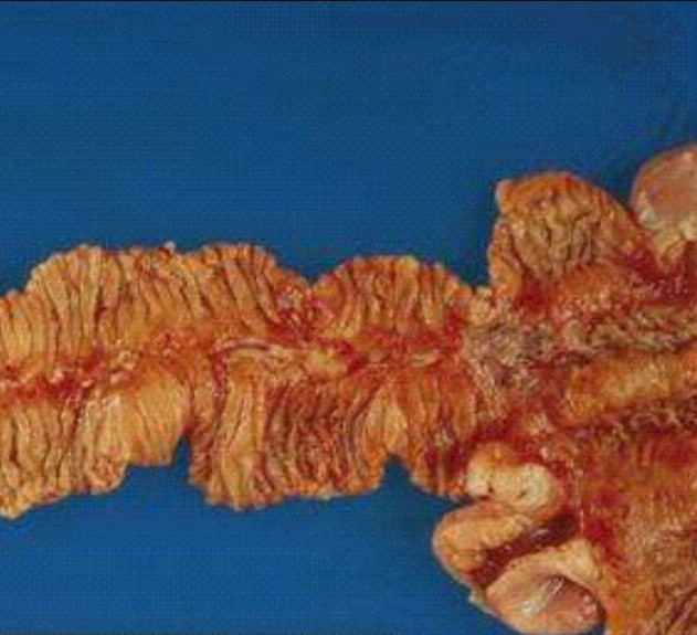 克羅恩病小腸部