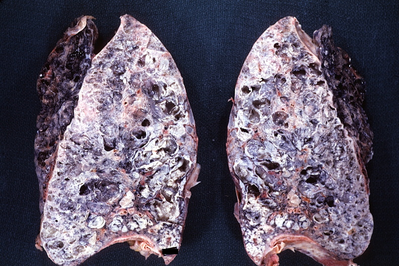 ＿原發性肺纖維化晚期