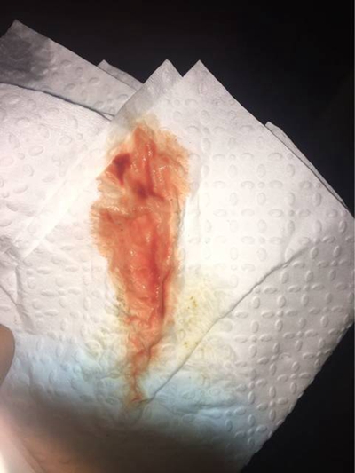 先兆流產分泌物