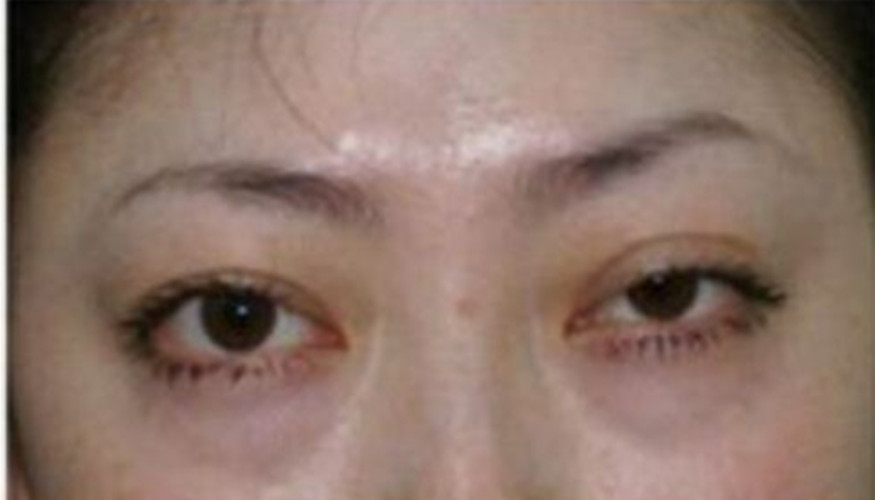 甲減眼部的水腫