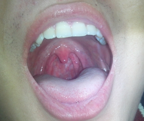 食道炎的症狀圖 (45) 