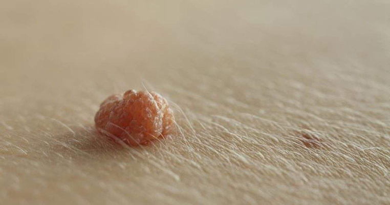 皮膚纖維瘤 (50) 