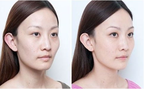 磨皮手術效果圖 (4) 