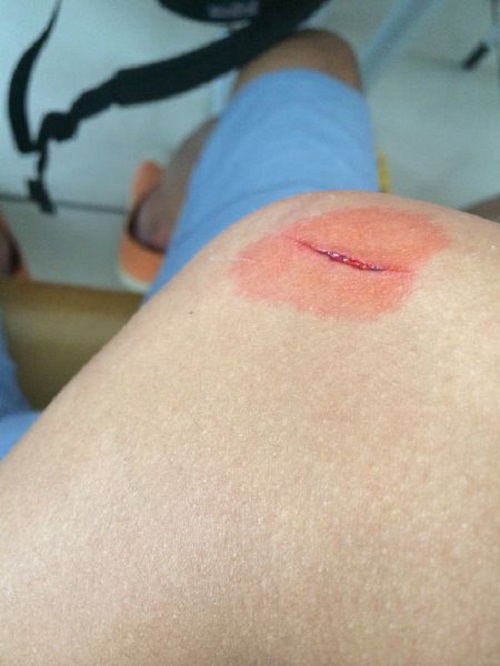 膝關節破傷風創口